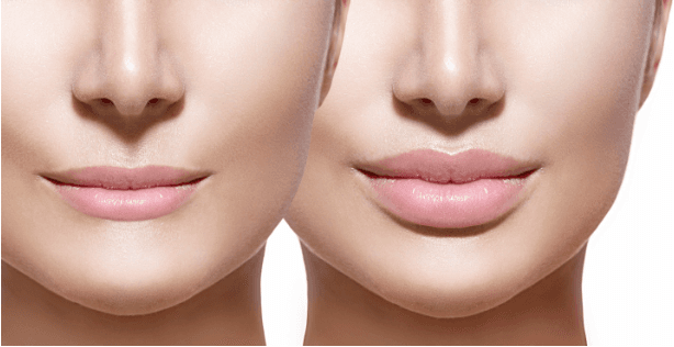 How Long Do Lip Fillers Last?